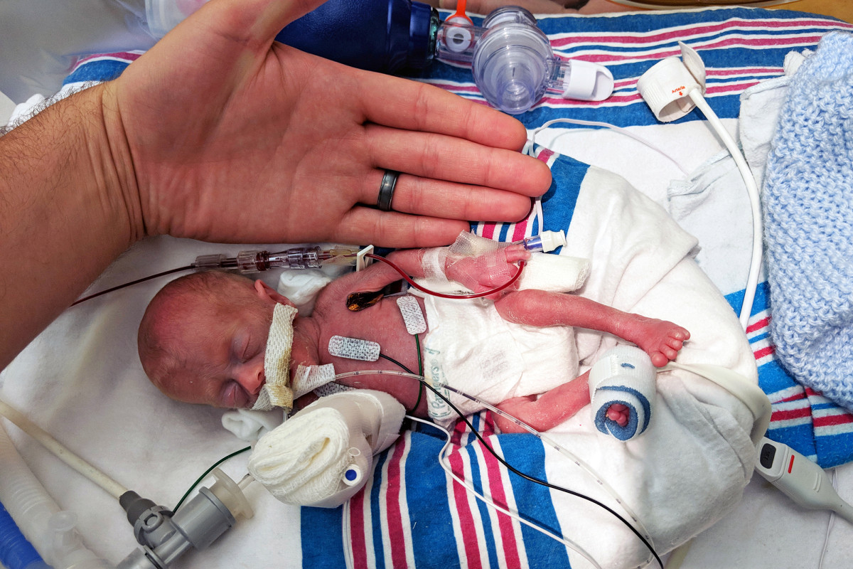 miraculous-micro-preemie-baby-shocks-the-world-mommy-underground